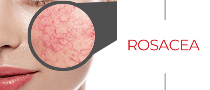 What is rosacea?