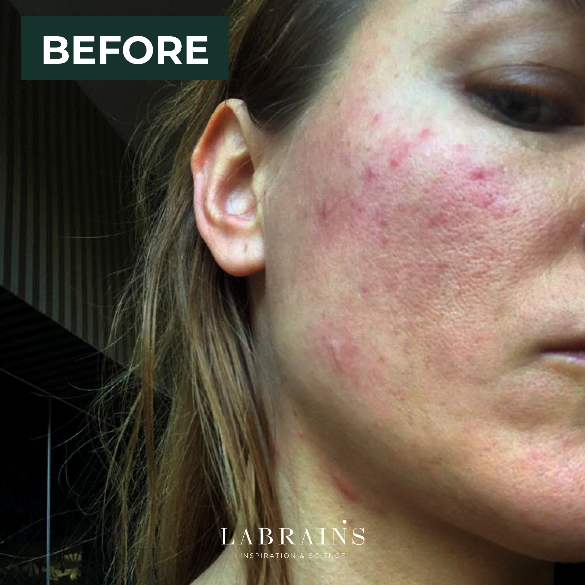 Liga Brunina, founder of LABRAINS, with severe rosacea before developing labrains skincare