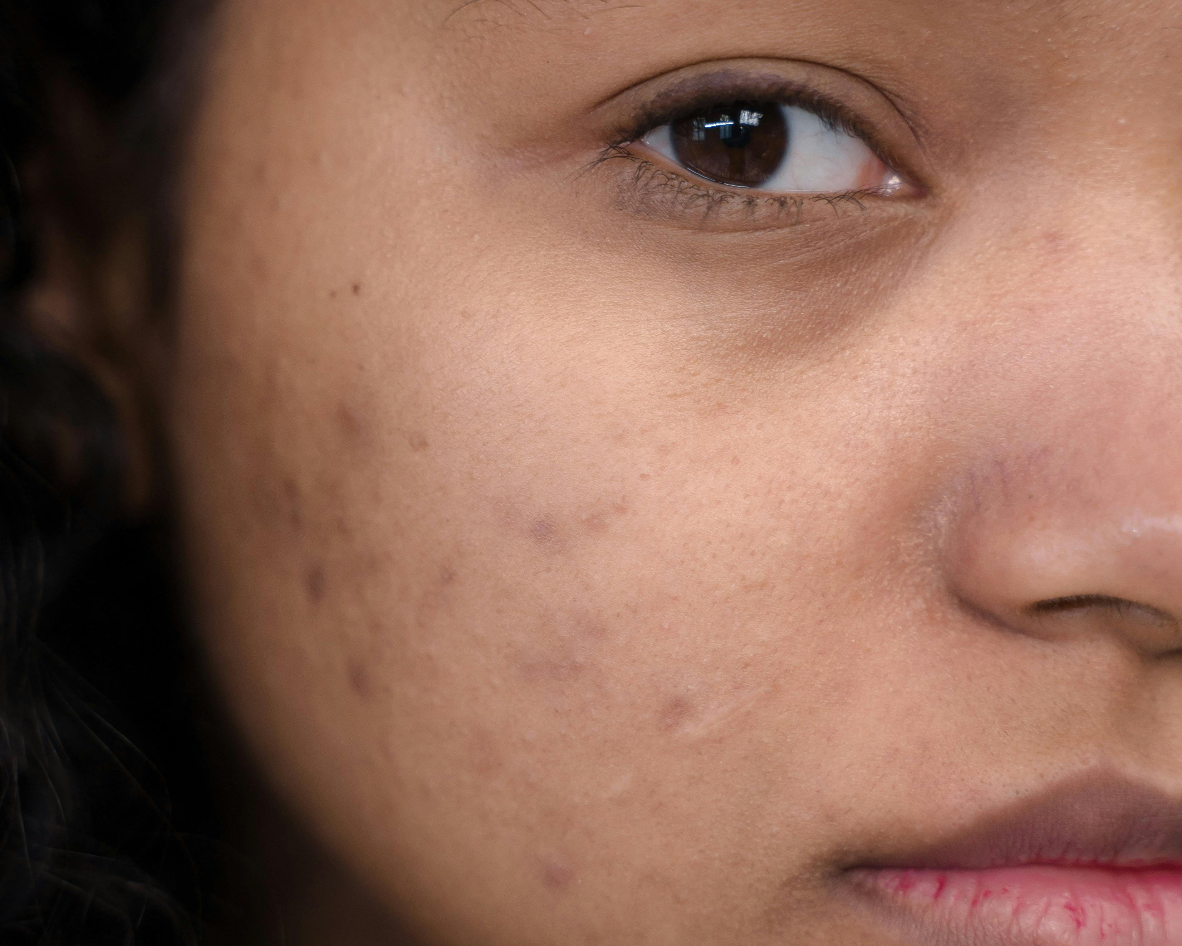 dark skin girl with acne
