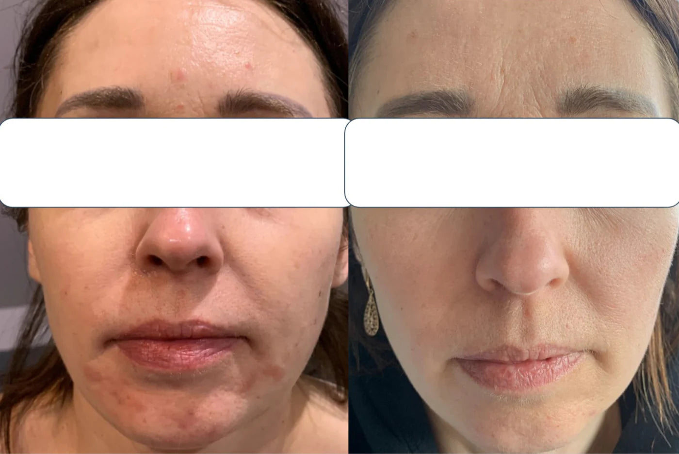 Before and after comparison of a woman's face with visible skin improvement.