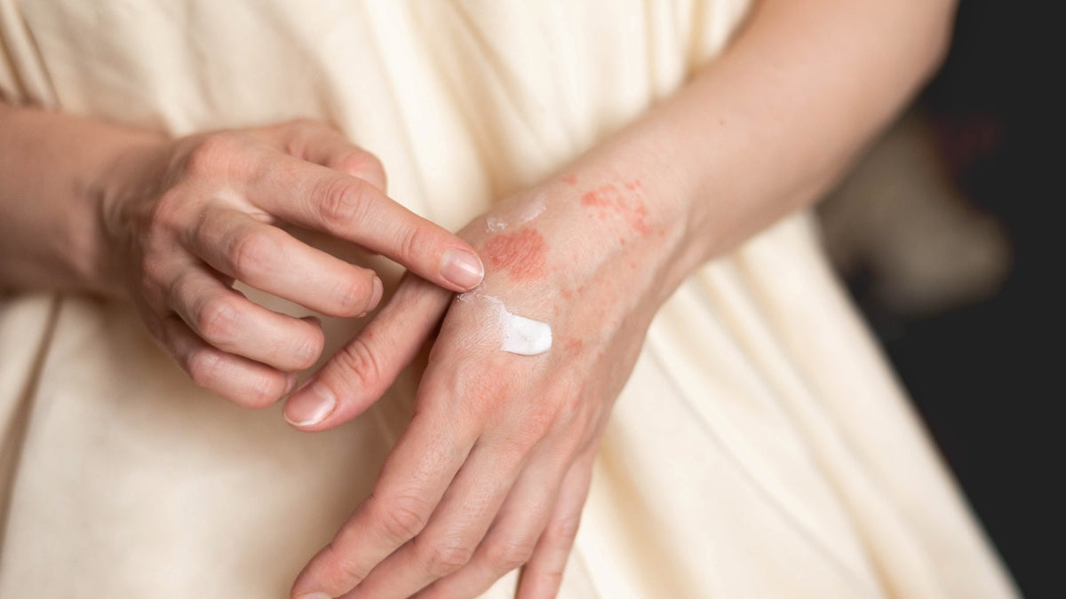 Dermatitis: Types, Symptoms and How to Care for Dermatitis-Prone Skin