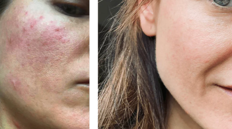 Understanding Rosacea