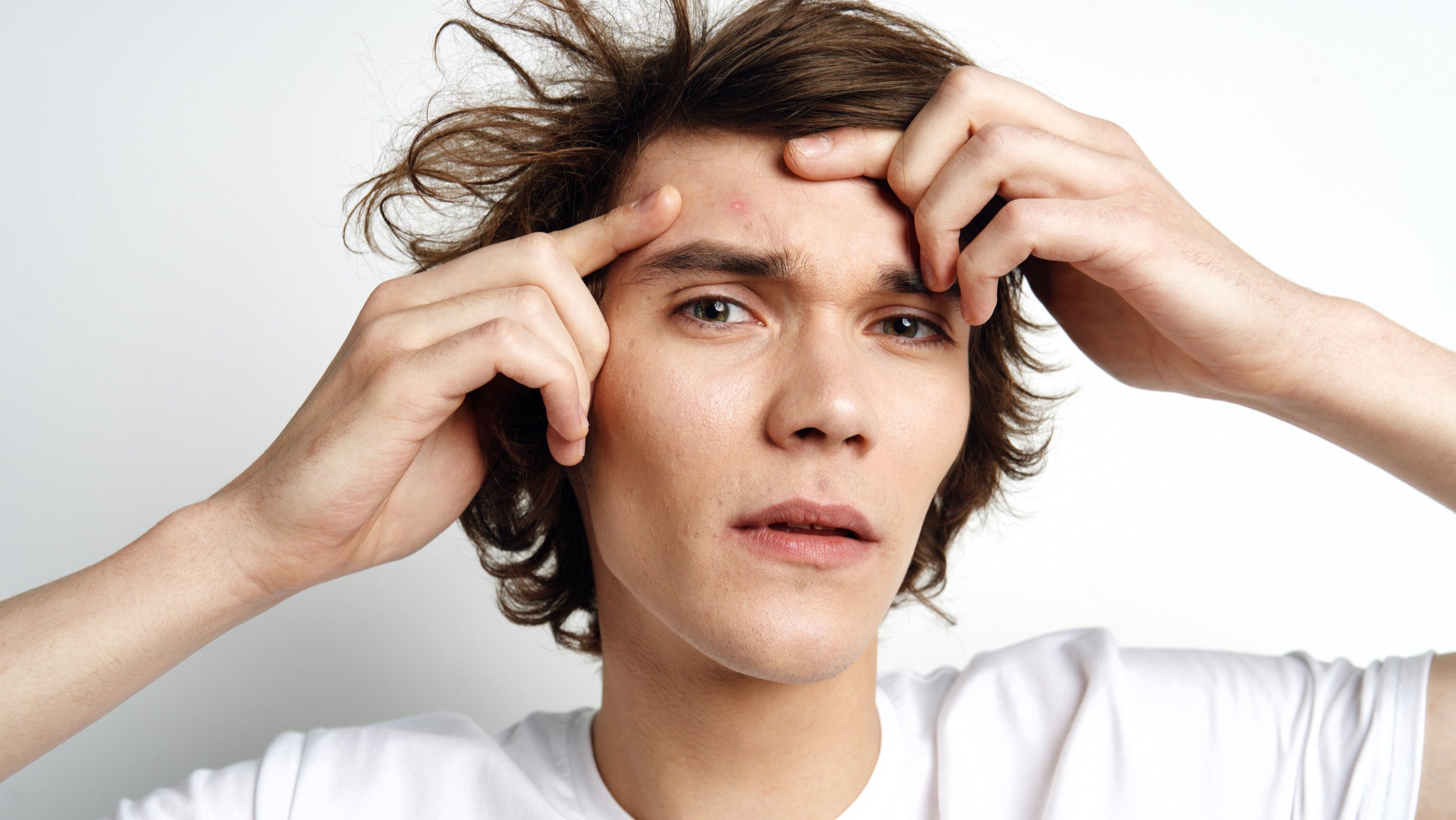 Understanding Acne: Pt3