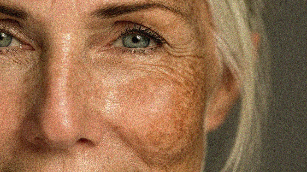 How to Treat Pigmentation Spots in Summer – And What to Avoid