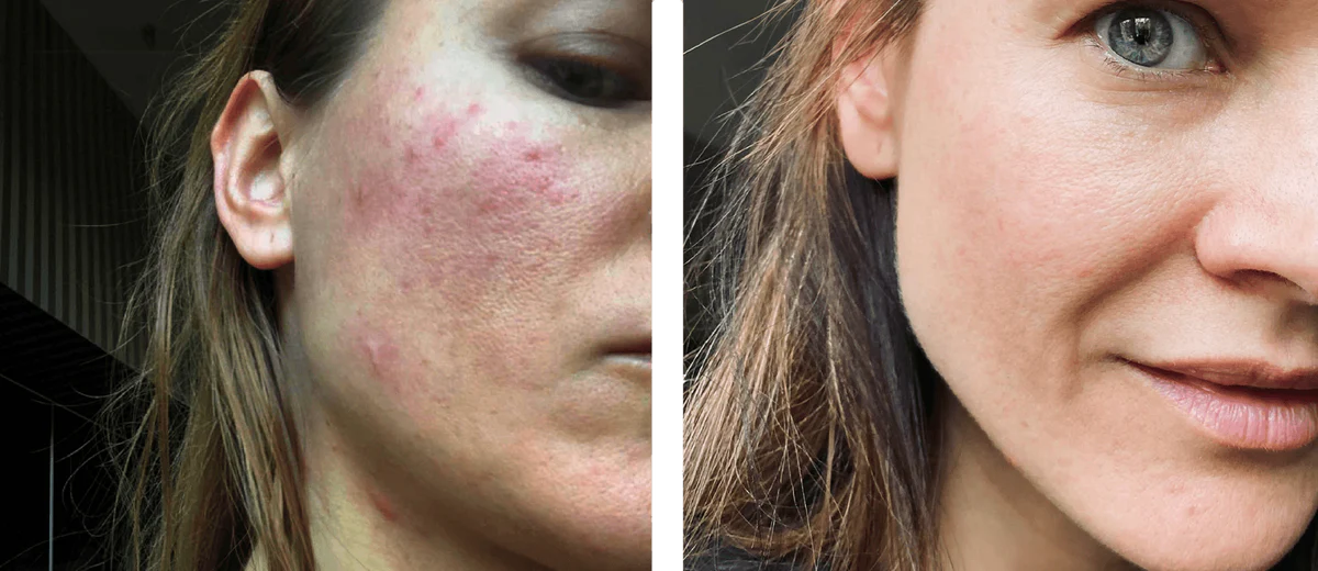 Close-up of Liga Brunina, the founder of Labrains, before and after treating rosacea 